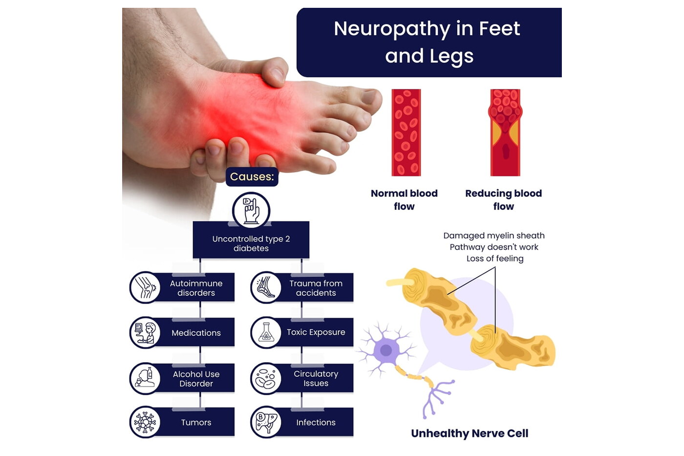 Infographic: neuropathy in the feet and legs, its causes, and how it affects blood flow and nerve function