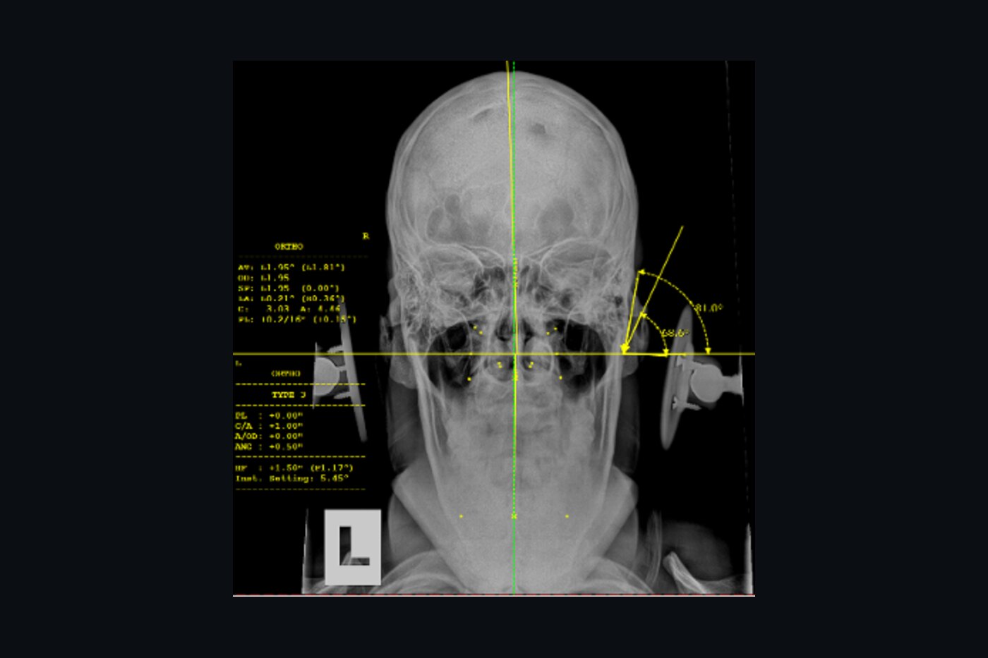 An upper cervical analysis x-ray showing precise alignment measurements of the atlas and skull