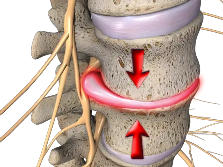Chiropractic Cape Coral FL Spine Red 1